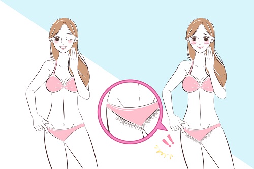 VIO脱毛の種類や形